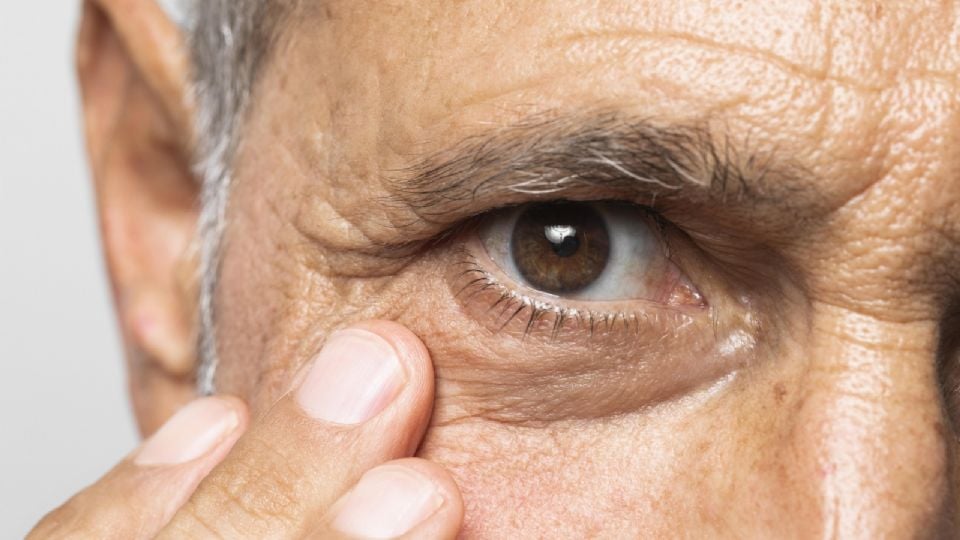 ¿Qué es el glaucoma y cuáles son sus síntomas?