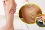 ¿Cómo se puede quitar las varices de forma natural? Estos son los alimentos que te ayudan a eliminarlas	