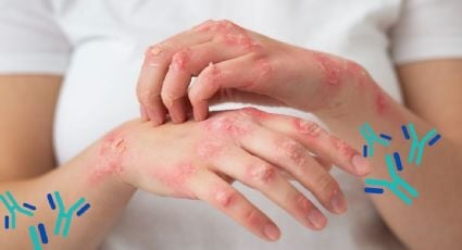 ¿Qué es la lepra y por qué da? Estas son sus principales causas y síntomas para detectarla