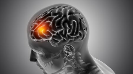 ¿Cómo identificar un microinfarto cerebral? Estos son sus síntomas y causas