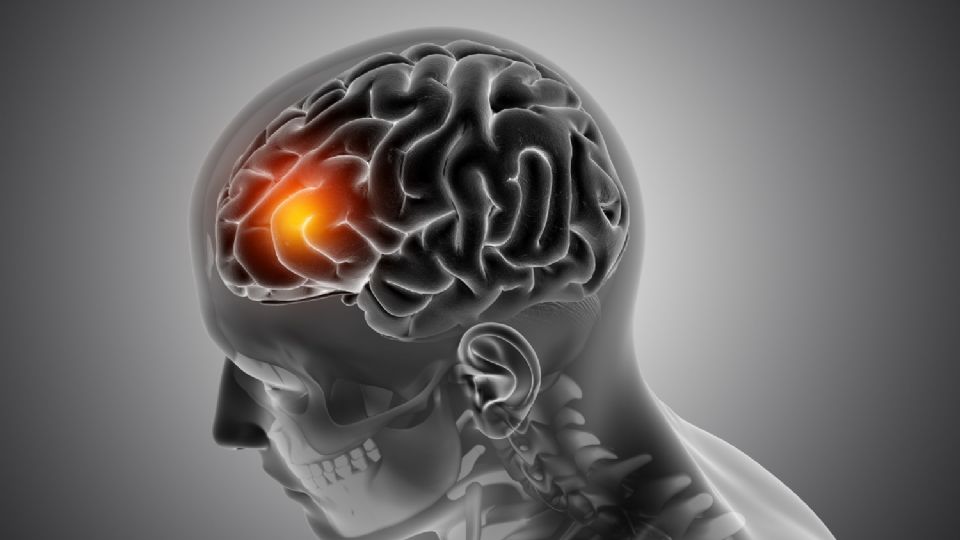 ¿Qué es y por qué da un microinfarto cerebral?