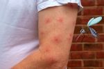 Foto ilustrativa de la nota titulada: ¿Por qué los mosquitos pican más a unas personas que a otras? Esto es lo que los atrae