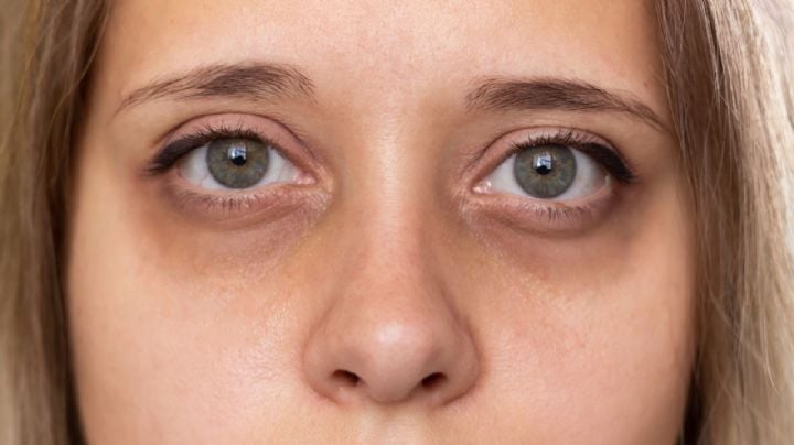 Despídete de las ojeras con estos sencillos remedios caseros