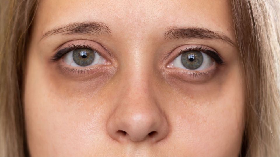 Despídete de las ojeras con estos sencillos remedios caseros