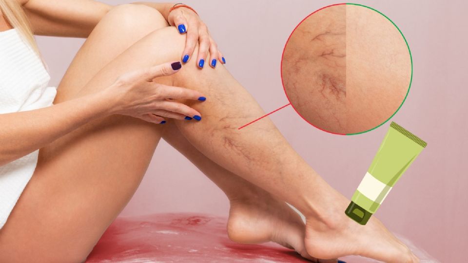 ¿Cómo aliviar las várices?